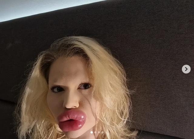 妹子丰唇27次，香肠嘴已经不足以形容了！疯狂到一天打6针